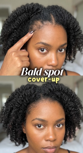 Before and after showing coverage of a sparse area near the hairline